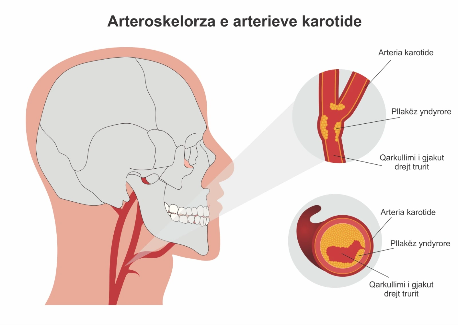 Diagram që paraqet arterosklerozën në arteriet karotide, me pllaka yndyrore që ngushtojnë arterien dhe pengojnë qarkullimin normal të gjakut drejt trurit.